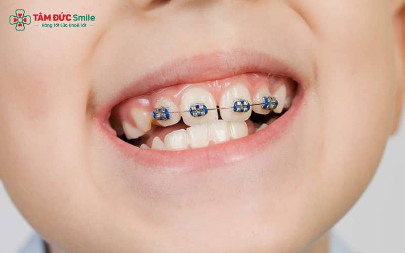 Trẻ 8 tuổi có cấu trúc xương hàm linh hoạt, tạo điều kiện thuận lợi để chỉnh nha hiệu quả