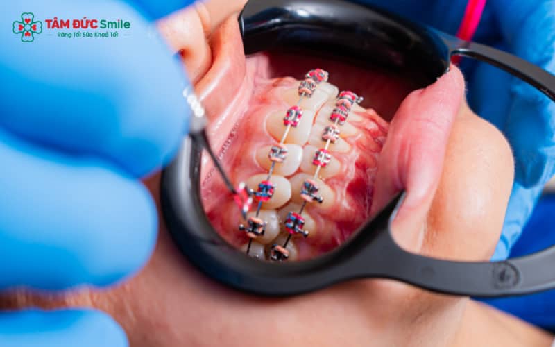 Trẻ em từ 6–12 tuổi niềng răng sẽ đạt hiệu quả tối ưu nhờ xương hàm còn mềm và dễ nắn chỉnh