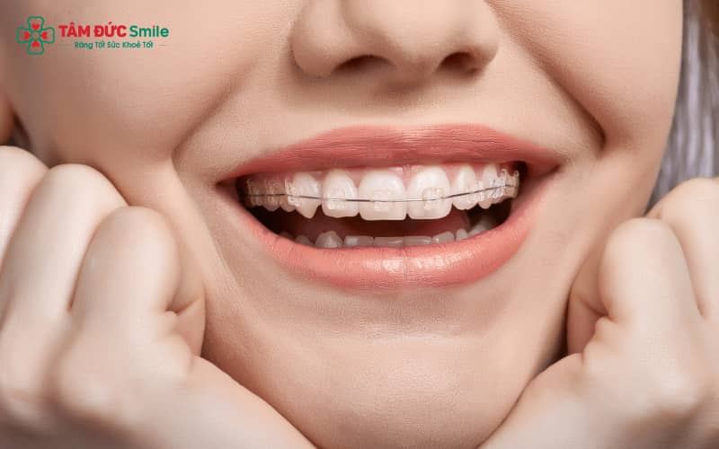 Niềng răng giúp cải thiện góc nghiêng, mang lại khuôn mặt cân đối hơn