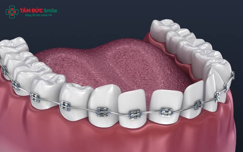 Niềng răng hoạt động nhờ lực tác động liên tục từ khí cụ lên răng và xương hàm