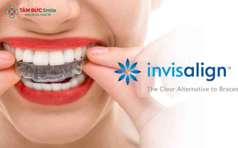 Quá trình điều trị Invisalign thường kéo dài 12 – 36 tháng, phụ thuộc vào đặc điểm răng miệng và mức độ hợp tác của bệnh nhân