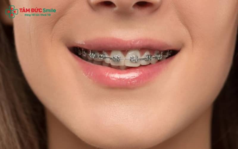 Thời gian niềng răng hàm móm dao động từ 1,5 đến 3 năm, phụ thuộc vào mức độ sai lệch
