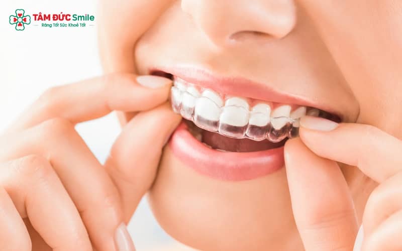 So với niềng răng mắc cài, niềng răng trong suốt thường gây ra mức độ đau và khó chịu thấp hơn