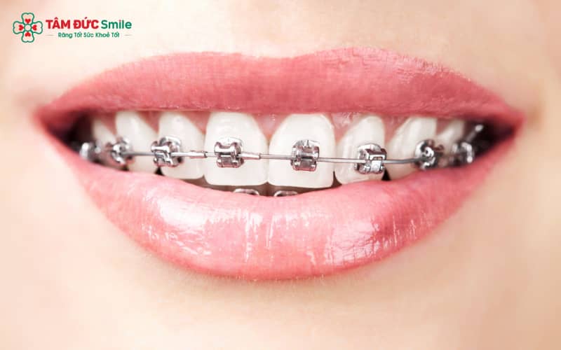 Niềng răng sắt đảm bảo hiệu quả, độ ổn định lâu dài, giá thành hợp lý và khả năng khắc phục đa dạng các vấn đề răng – hàm