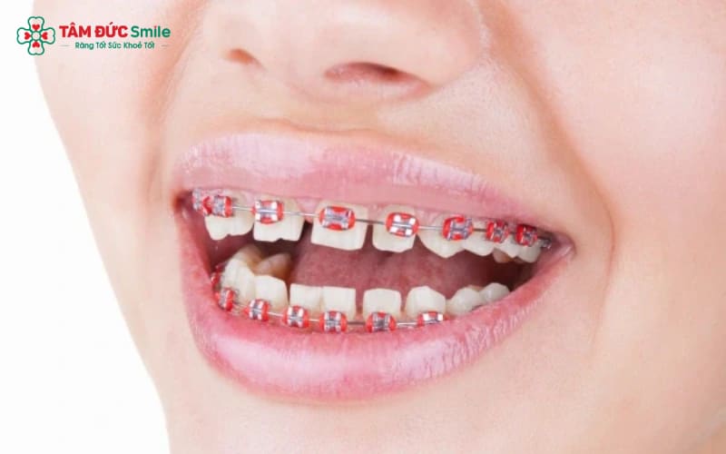 Thời gian niềng răng thưa thường kéo dài từ 6 – 24 tháng, tùy vào mức độ thưa và kế hoạch điều trị