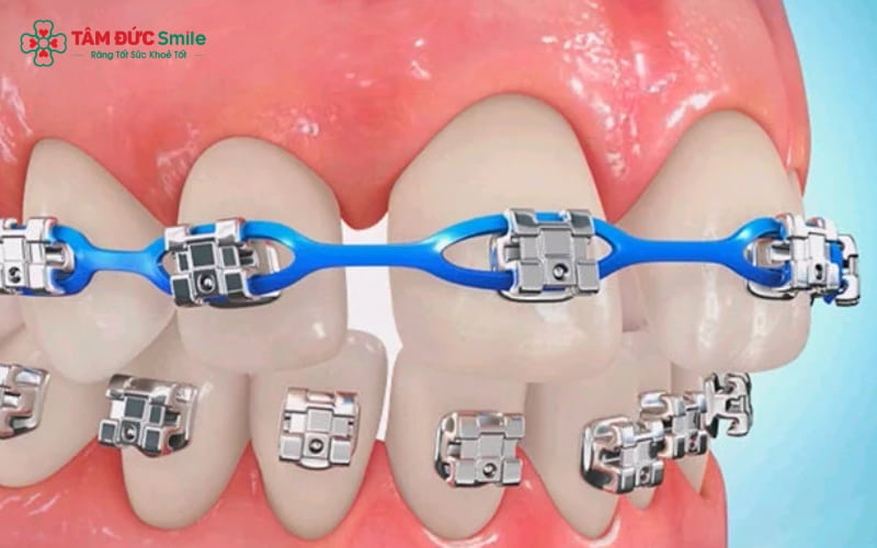 Để có lộ trình niềng răng rõ ràng, bạn cần được bác sĩ chuyên khoa thăm khám và tư vấn trực tiếp