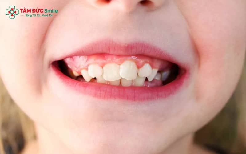 Niềng răng là giải pháp cho tình trạng răng khấp khểnh hoặc mọc chen chúc