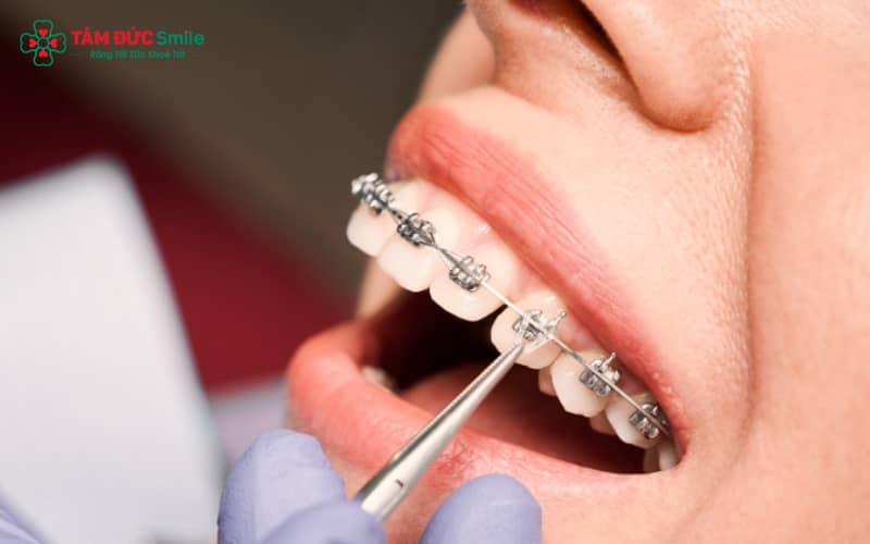 Niềng răng không chỉ điều chỉnh răng lệch lạc mà còn tăng hiệu quả ăn nhai