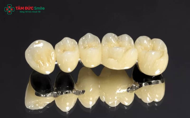 Hiện tượng răng sứ titan xỉn màu do oxy hóa khung kim loại