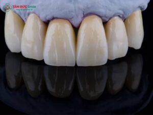 Răng sứ Titan có mấy loại? Phân biệt từng loại, giá & độ bền chi tiết