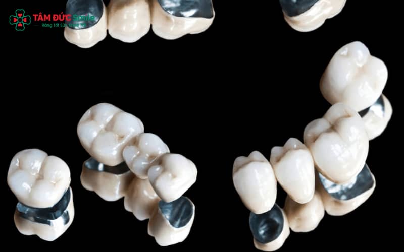 Quý khách cần lựa chọn răng sứ Titan phù hợp với tình trạng răng và ngân sách