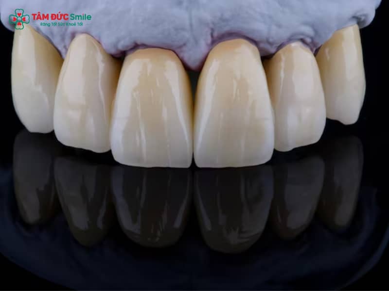 Răng sứ Titan có mấy loại? Phân biệt từng loại, giá & độ bền chi tiết