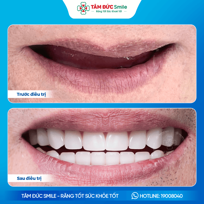 trong-rang-implant-all-on-4-2
