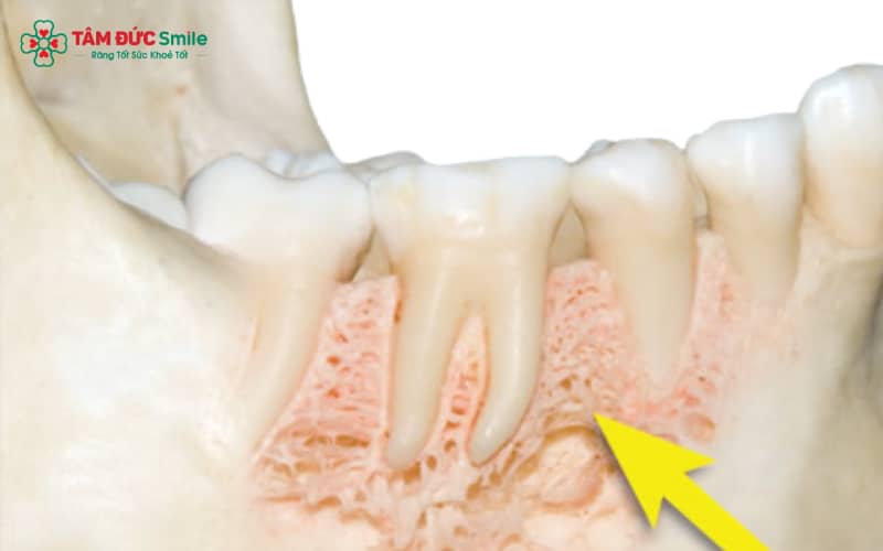 Xương ổ răng hình thành từ hai cấu trúc cơ bản: xương ổ chính danh và xương ổ nâng đỡ