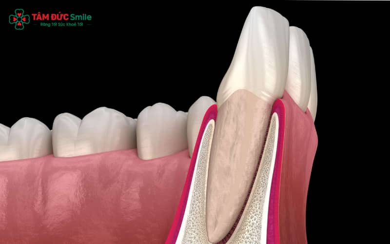 Tiêu xương ổ răng thường biểu hiện rõ sau 3–6 tháng kể từ khi mất răng