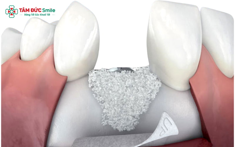 Implant đặt sớm sau nhổ răng sẽ thay thế chức năng chân răng, từ đó ngăn ngừa tiêu xương ổ răng