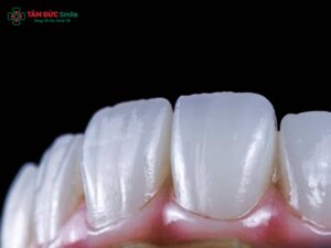 Bảng màu răng sứ Cercon HT có mấy màu? Chọn tone trắng tự nhiên nhất