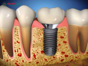 Bao nhiêu tuổi thì trồng răng Implant được? Độ tuổi phù hợp và điều kiện