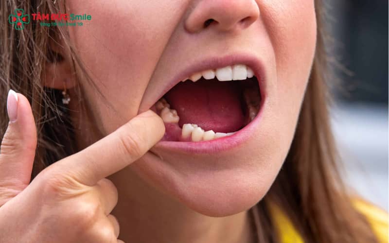 Sâu răng nghiêm trọng, viêm nha chu, chấn thương, răng mọc lệch hoặc yếu tố tuổi tác–di truyền đều có thể dẫn đến mất răng cấm