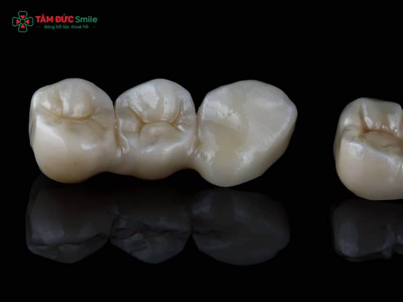 Cảm giác sau khi bọc răng sứ thường gặp: ê buốt, đau nướu, cộm khớp cắn