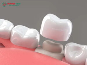 Bọc răng sứ bao lâu thì ăn được? Hướng dẫn chăm sóc và kiêng ăn đúng cách