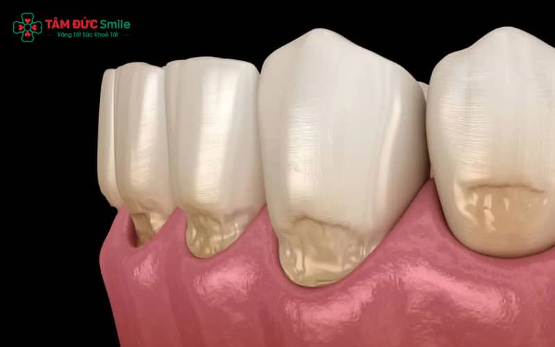 Dấu hiệu dễ nhận biết: hôi miệng, ê buốt, nướu thâm – đỏ và khoảng hở rõ giữa răng sứ và nướu.