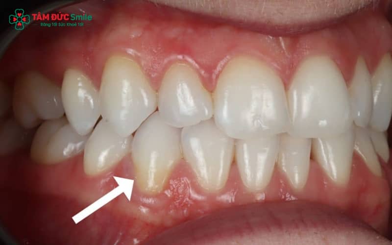 Răng sứ bị hở chân thường do mài răng sai kỹ thuật, keo dán yếu hoặc phục hình sai khớp cắn