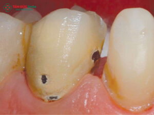 Vì sao bọc răng sứ bị hỏng? Nguyên nhân, dấu hiệu và cách khắc phục