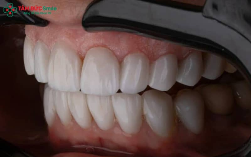 Các dòng răng sứ cao cấp như Emax, Zirconia, Lava Plus giúp chỉnh hình răng cửa hô nhẹ, vừa thẩm mỹ vừa bền chắc