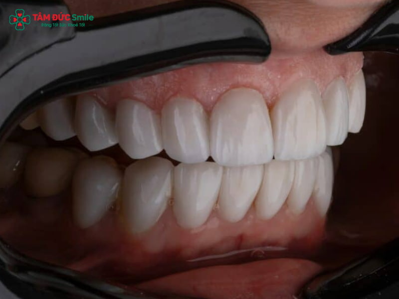 Bọc răng sứ cho răng cửa bị hô được không? Giải pháp an toàn, thẩm mỹ cao