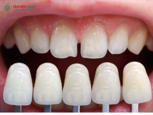 Bọc răng sứ có bị sâu răng không? Nguyên nhân và cách phòng ngừa