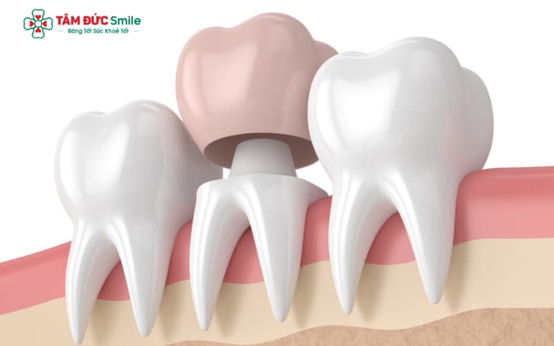 Răng viêm tủy, sâu lớn hoặc vỡ sát tủy cần điều trị tủy trước khi bọc sứ để tránh đau nhức và biến chứng