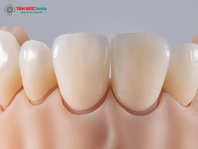 Bọc răng sứ có nguy hiểm không? Rủi ro, biến chứng, cách phòng an toàn!