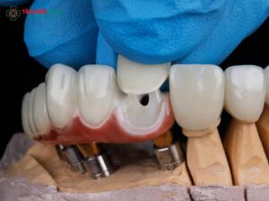 Bọc răng sứ có phải mài răng không? Giải pháp bảo tồn răng thật an toàn