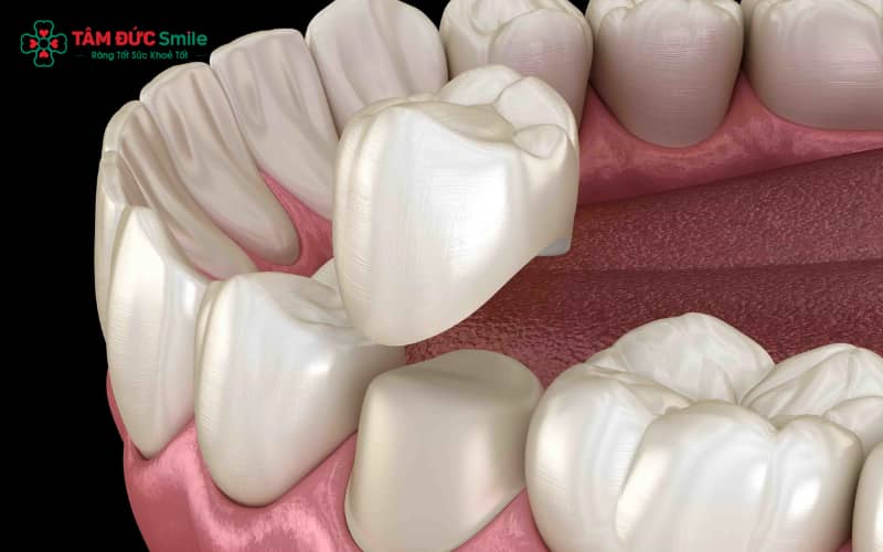 Bọc răng sứ thông thường không cần nhổ răng, bác sĩ chỉ mài nhẹ phần men răng để chụp mão sứ bảo vệ bên ngoài