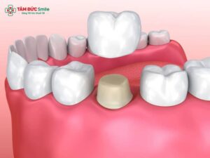 Bọc răng sứ có phải nhổ răng không? Giải đáp chi tiết, an toàn
