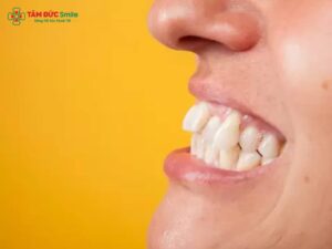 Bọc sứ răng khểnh có được không? Giải pháp cho nụ cười duyên dáng