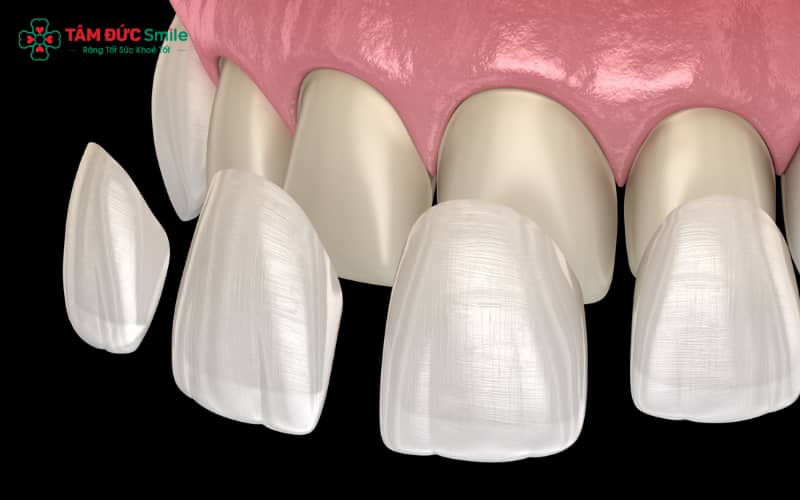 Bọc răng sứ không mài thực chất là dán sứ Veneer siêu mỏng lên bề mặt răng, hầu như không xâm lấn