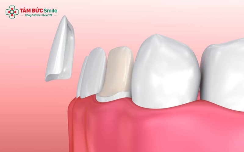 Dán sứ Veneer mang đến thẩm mỹ tự nhiên, không đau, không mài răng và đảm bảo răng thật được bảo tồn tối đa