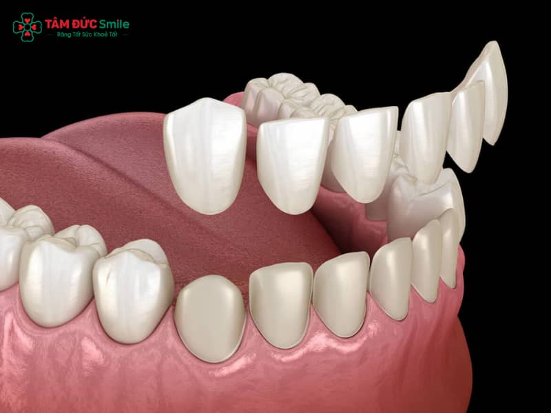 Bọc răng sứ không mài là gì? Giải pháp thẩm mỹ răng tự nhiên, an toàn