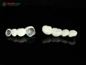 Bọc răng sứ kim loại có tốt không? Ưu nhược điểm cần biết