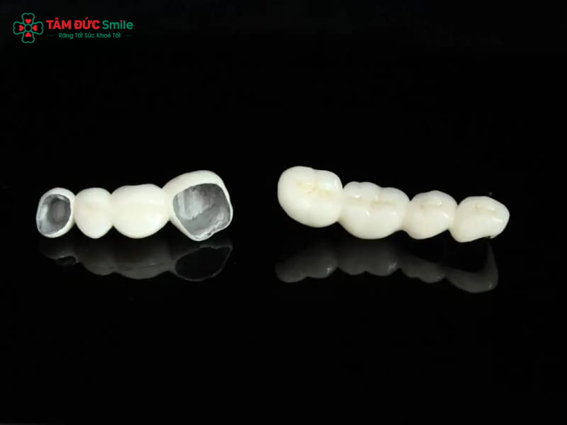 Bọc răng sứ kim loại có tốt không? Ưu nhược điểm cần biết