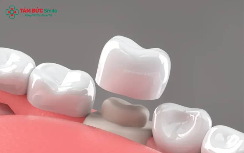 Dấu hiệu cần thay răng sứ: hở nướu, đổi màu, răng sứ lung lay hoặc sứt mẻ theo thời gian.