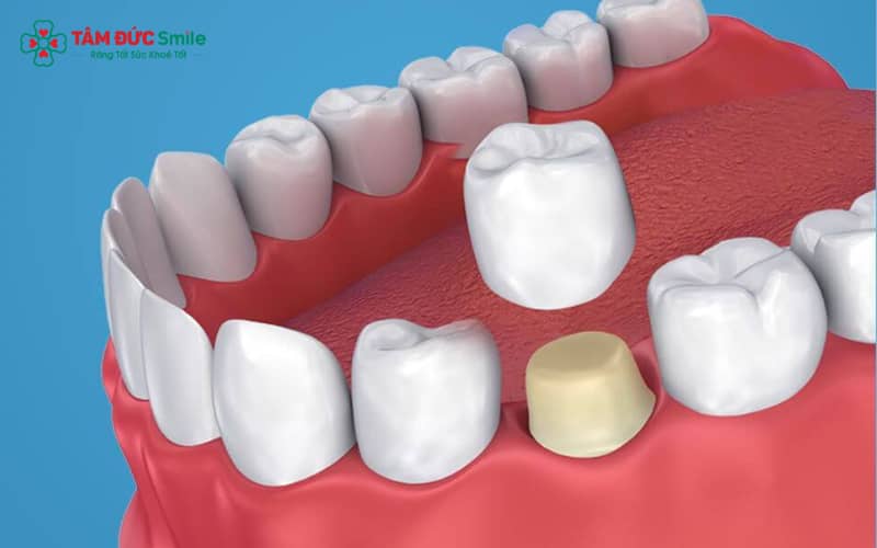 Bọc răng sứ lần 2 được khuyến nghị khi răng sứ cũ bị xuống cấp, ảnh hưởng thẩm mỹ hoặc chức năng nhai