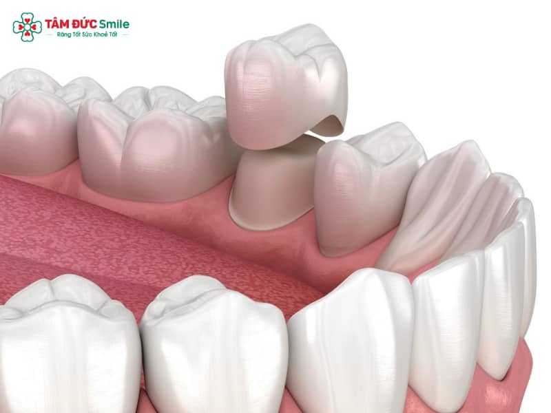 Khi nào nên bọc răng sứ lần 2: dấu hiệu hở nướu, xỉn màu, lung lay nhẹ
