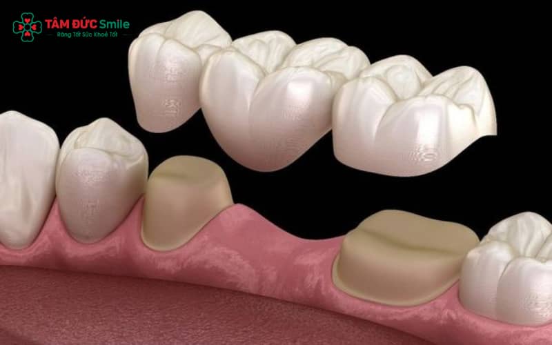 Răng sứ kim loại có cấu tạo gồm phần khung kim loại bên trong và lớp sứ phủ ngoài giúp khôi phục hình dáng, chức năng ăn nhai