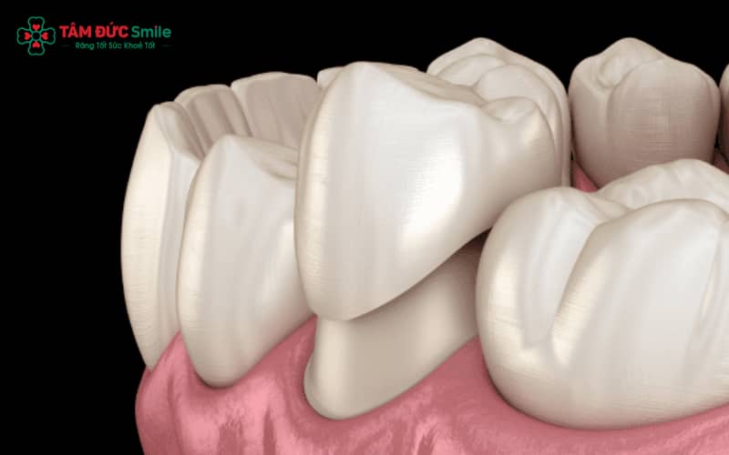 Răng sứ kim loại Titan nhẹ, bền và tương thích sinh học tốt hơn so với răng sứ kim loại thường