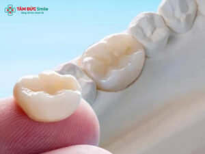 Răng Sứ Kim Loại Là Gì? Cấu Tạo, Ưu Nhược Điểm