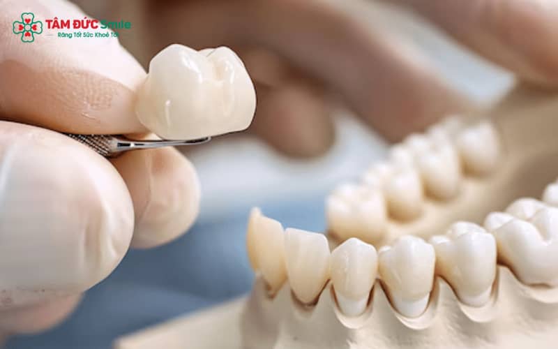 Sau thời gian sử dụng, răng sứ kim loại có thể làm đen viền nướu, ảnh hưởng đến tính thẩm mỹ của nụ cười