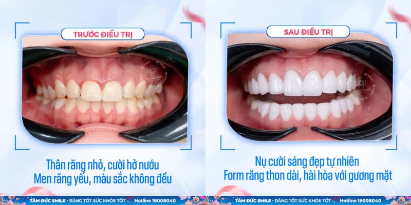 Bọc răng sứ sinh học mang lại vẻ đẹp tự nhiên, độ bền cao và không đổi màu theo thời gian